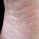 Отрубевидное шелушение в кожных бороздах на фоне кератоза