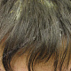Стрептококковое импетиго волосистой части головы
