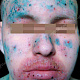 Точечные эрозии и язвы на лице, периоральный очаг лихенификации кожи