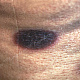 Характерен пепельно-серый цвет в центральной части высыпания, окружённого воспалительным ободком