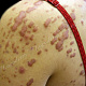 Гипертрофические рубцы после конглобатных угрей на плече и спине