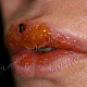 Отёчная форма герпеса - выраженный отёк обеих губ
