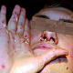 Герпес на носу и высыпания полиморфной эритемы на ладонях