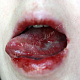 Синдром Стивенса-Джонсона поражена слизистая полости рта