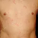 Фигурные волдыри на груди и животе