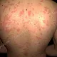 Локализация сыпи на туловище: область лопаток и пояснично-крестцовая область со слиянием отдельных элементов