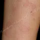 При крапивнице волдыри быстро и бесследно разрешаются