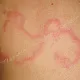 Фигурные волдыри, разрешающиеся в центре и растущие по периферии