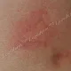 Волдырь белого цвета