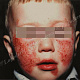 Диатез у ребенка 3-х лет - пузырьки, эрозии, корки на фоне воспалительных пятен