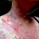 Появление микровезикул, эрозий и мокнутия в местах воспаления кожи